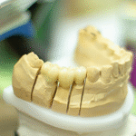 インプラントとブリッジの違いとは？どちらが最適？