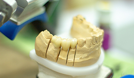 インプラントとブリッジの違いとは？どちらが最適？